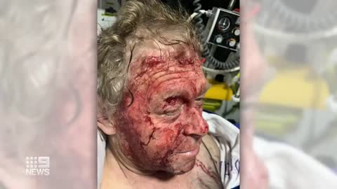 Man shot in the face after confronting burglars 9 News Australia