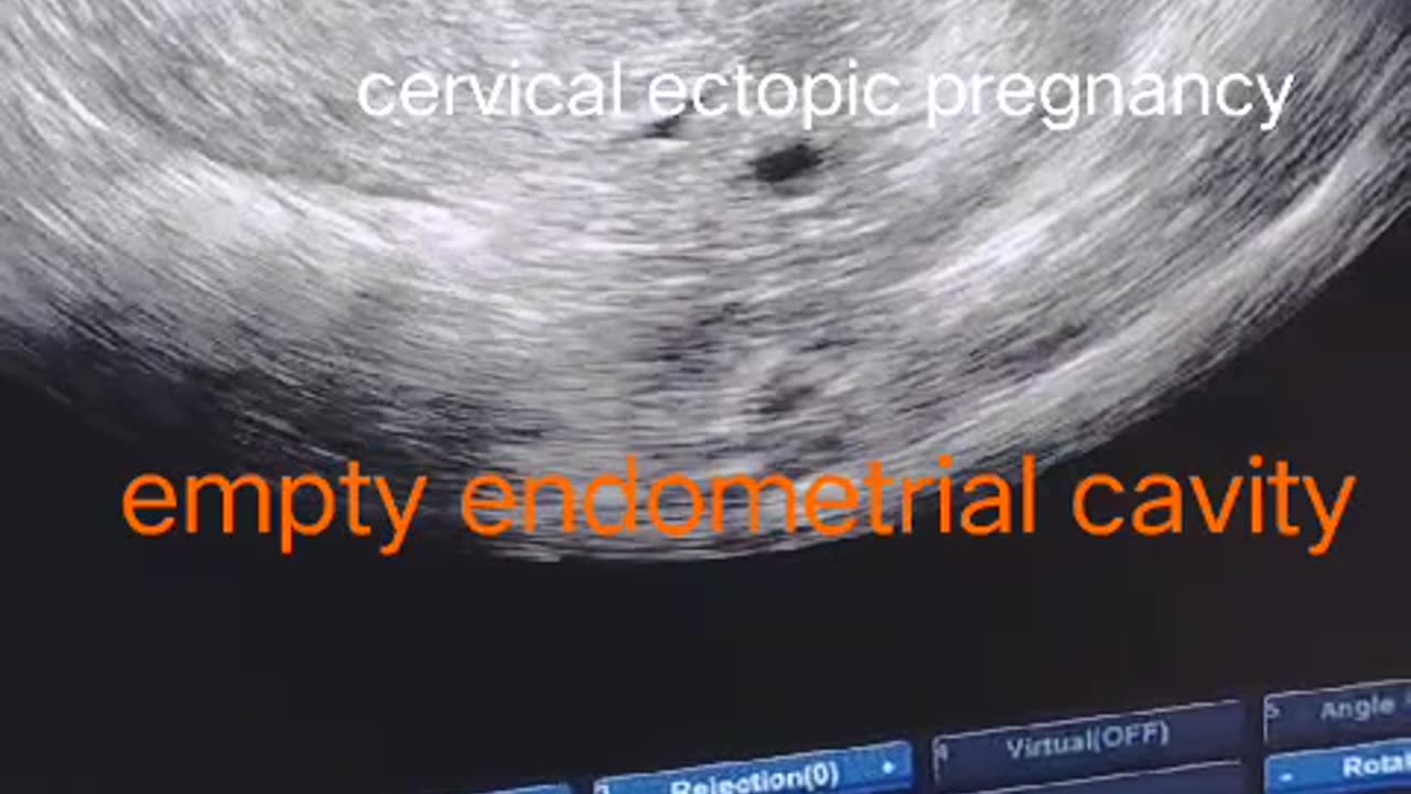 Cervical ectopic pregnancy