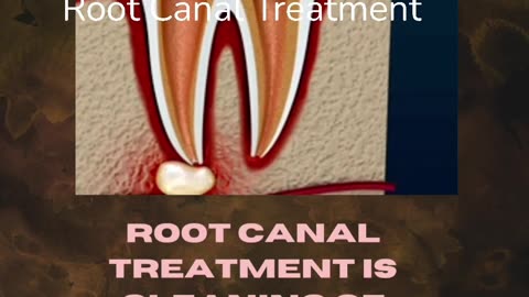 Root canal treatment