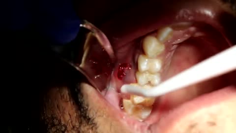 Juicy Dental Abscess Popped