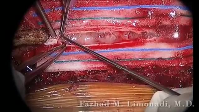 Spine Tumor Removal of Thoracic Schwannoma: Actual footage of Spine Surgery