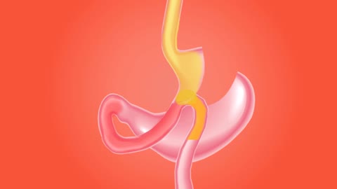 Mini gastric bypass procedure