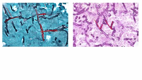 Opportunistic Fungal Infections