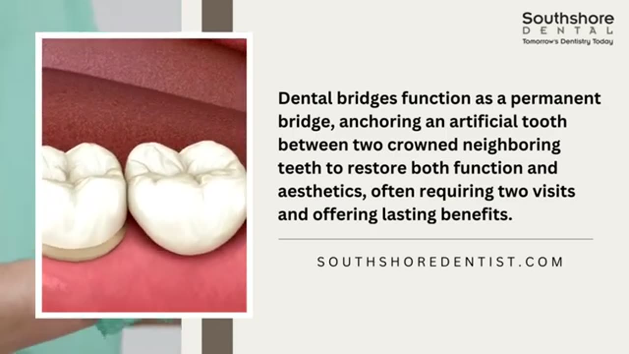 Benefits Of A Dental Bridge