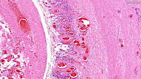 DR BHAKDI & DR PALMER'S COMPELLING EVIDENCE THAT C19 VACCINES CAUSE VASCULAR AND ORGAN DAMAGE