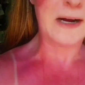 I vaccini non proteggono dal sole....