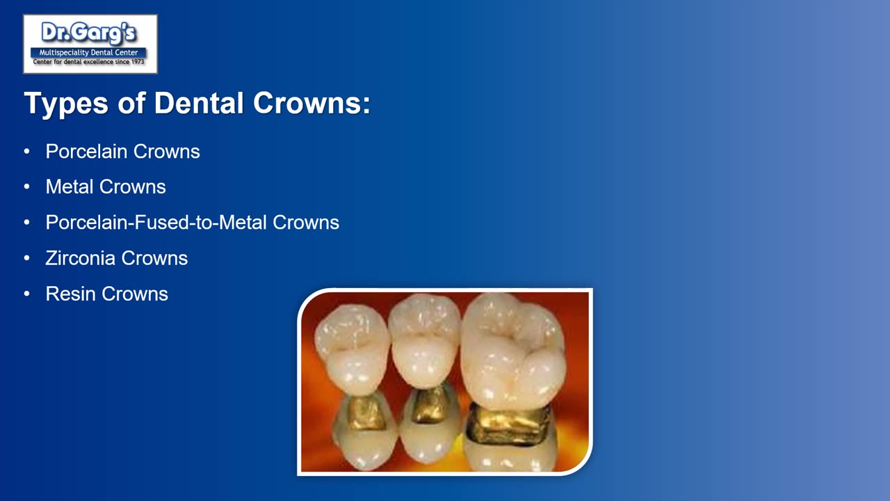 Durability Meets Beauty The Advantage of Dental Crowns