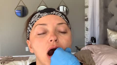Before and After Lip Filler