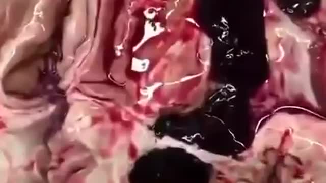 VERY GRAPHIC: Clots In The Brains Of People Killed By The Vaccine