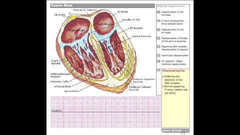 Dr Stanley's ECGcourse.com | Fusion Beat Tutorial