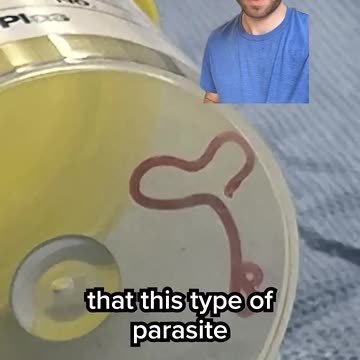 A live worm was found inside a woman's brain