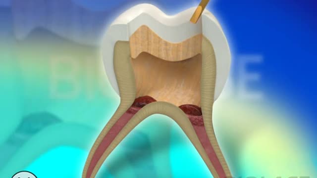 dental-restoration