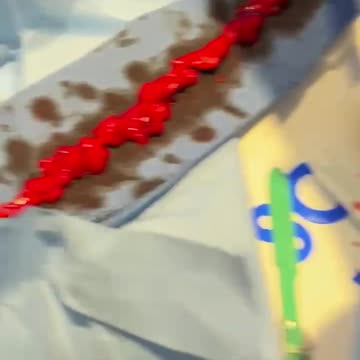 myocarditis after vaccine