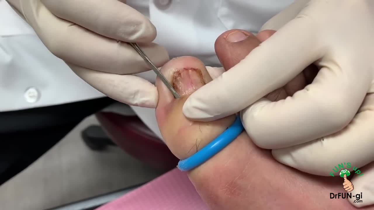 Juicy Ingrown ToeNail Removal