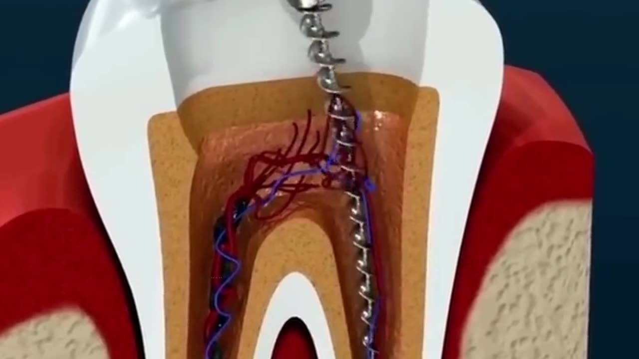 Root Canal Therapy (R.C.T) In 3D Animation