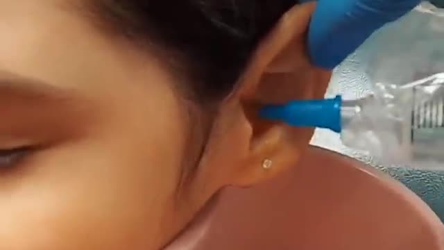 Ear wax removal (Ear cleaning)