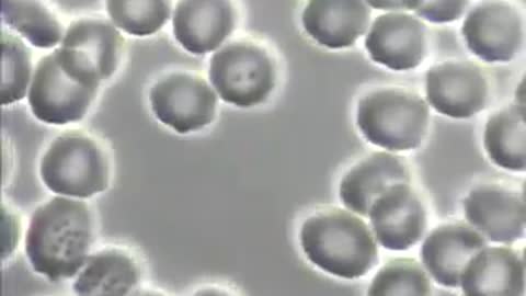 COVID Vaxx Blood Under a Microscope