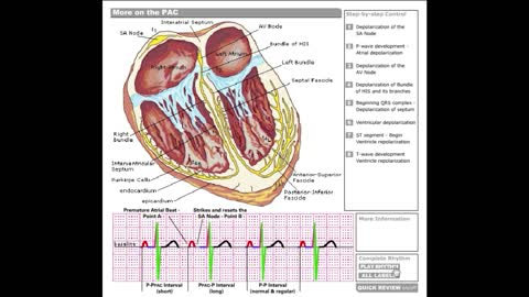 Dr Stanley's ECGcourse.com | More on the PAC - Tutorial