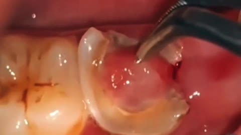 Broken tooth with swelling of pulp