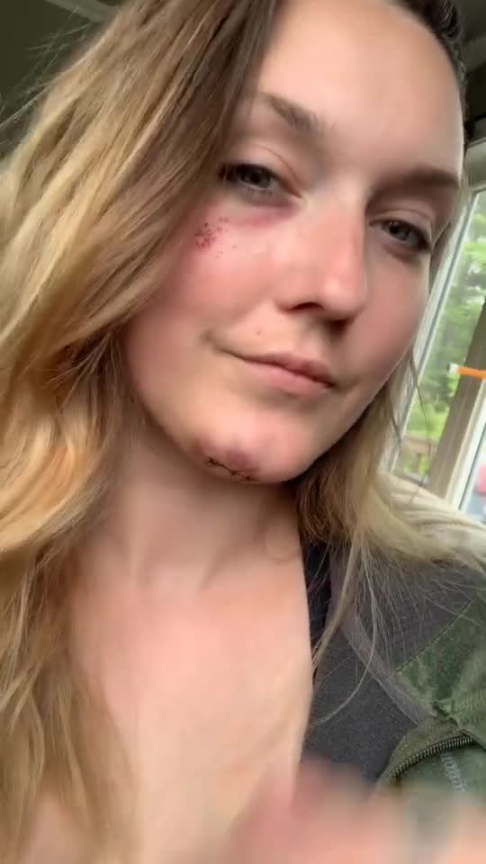 Because i’m clumsy as hell￼ 😂🛹 accident skateboard fail lol day2 imalive oops