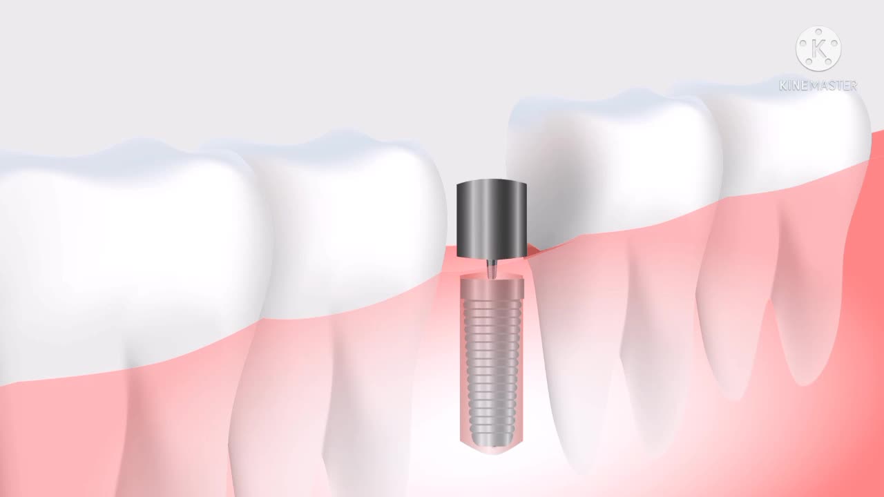 Teeth Fixing video, smart ways teeth Fixing