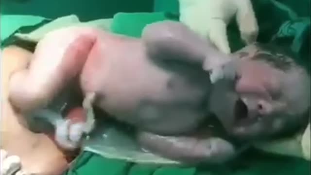 HUGE BABY BORN under CAESAREAN SECTION.