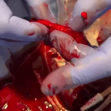 magnetic graphene structures "Clots" pulled from deceased covid vaccine patients