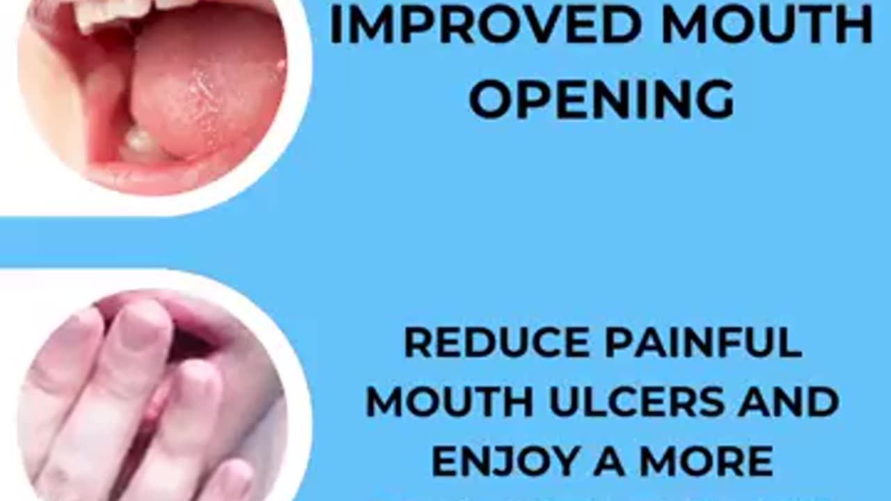 30 Minute Fast Treatment to Heal OSMF — OLI Therapy By Dr. Agravat