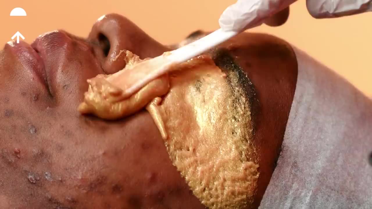 EXTREME Facial to Get Rid of Acne and Hyperpigmentation