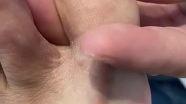 INGROWN TOENAIL REMOVAL