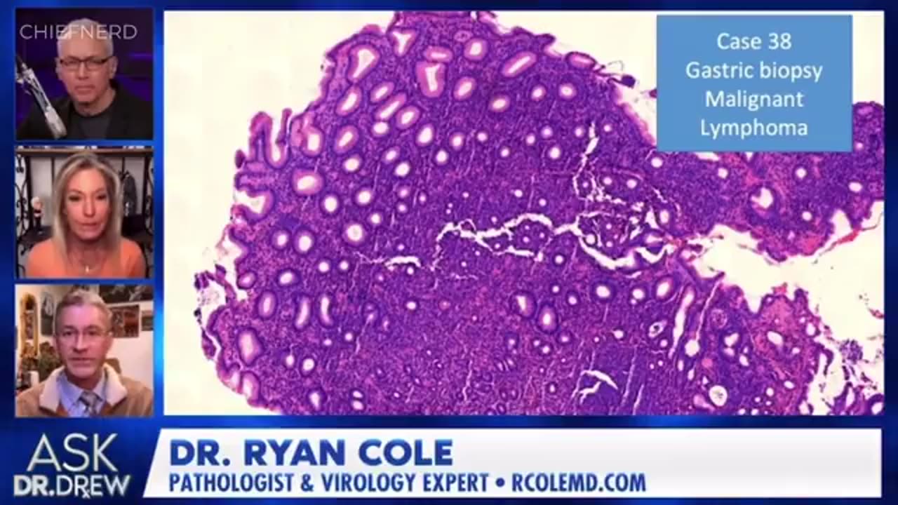 Dr. Cole - Images Show Spike Protein is Inside EVERY Cancer Cell