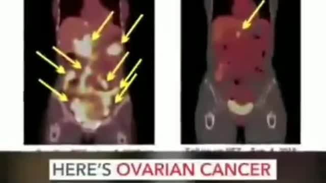 Anticancer peptides ? 🤔