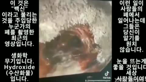 폐 촬영