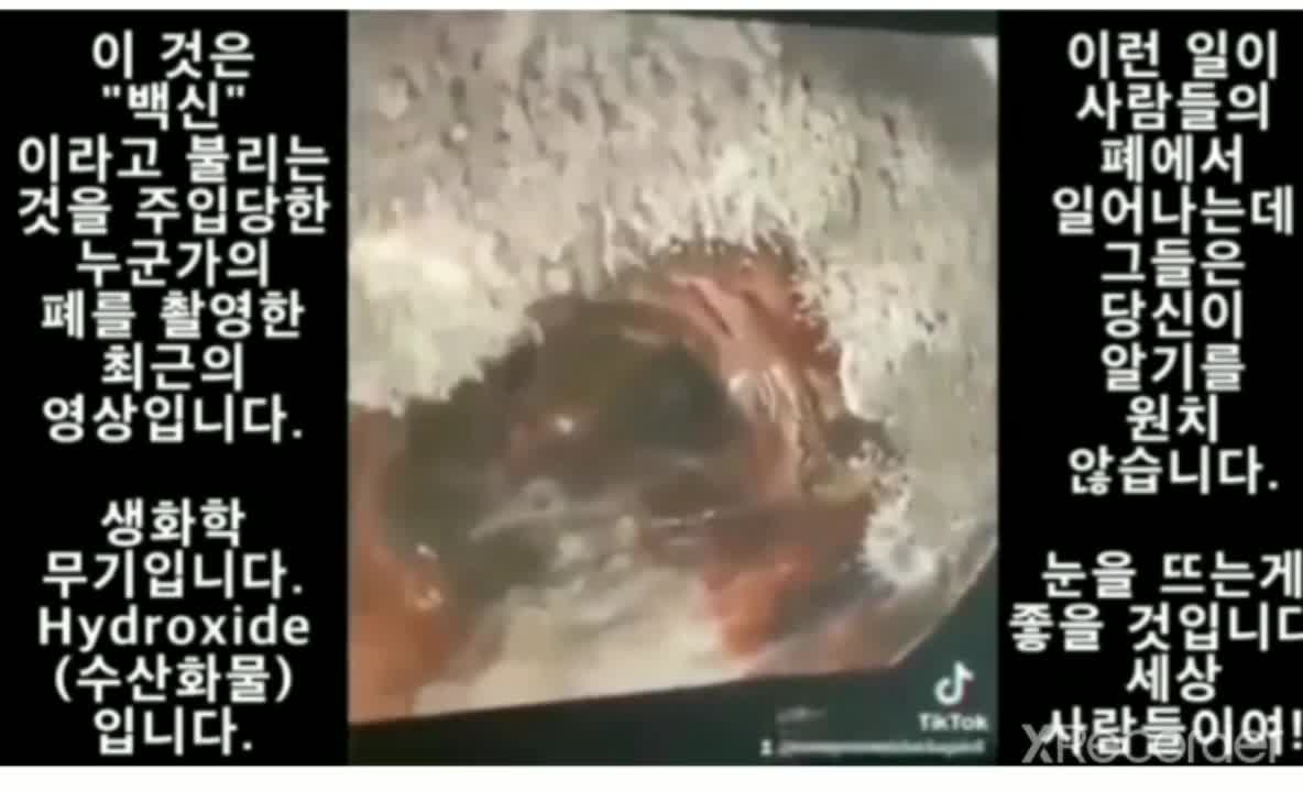 폐 촬영
