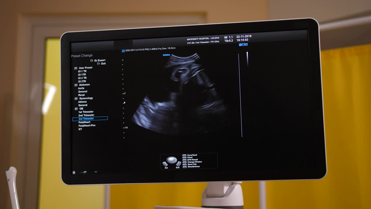 Ultrasound scan on a monitor