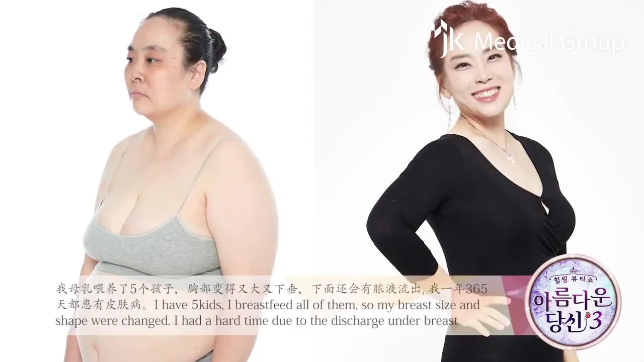 Full Body Liposuction at JK! Korean Plastic Surgery