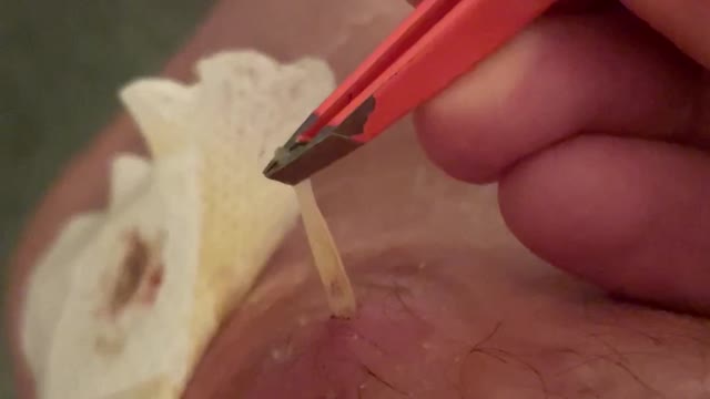 Removing a Larva That Grew in my Leg for 5 Weeks