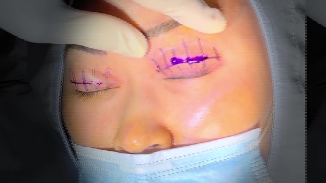 Precise & Painless: Dr. Kim's Local Anesthetic Technique for Ptosis & Double Eyelid Surgery