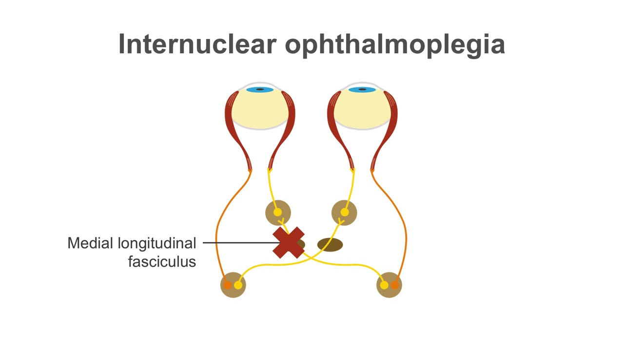 Clinical Neurology Essentials 6.Recognizing dysconjugate gaze