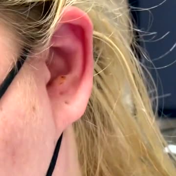 Newest pimple removal 2022 - Cystic acne extractions whiteheads new-