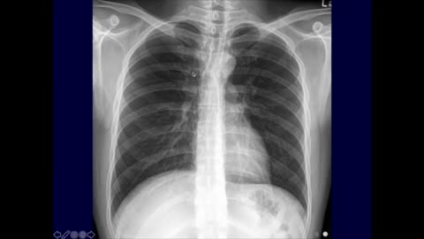 Chest X-ray - Introduction