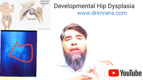 Developmental Hip Dysplesia