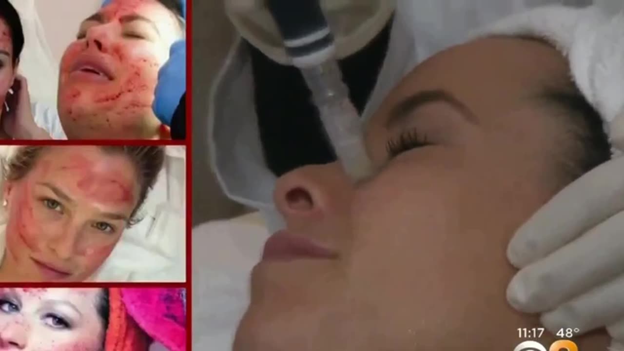 2009: CBS runs story talking about using a teenager's blood to reverse aging