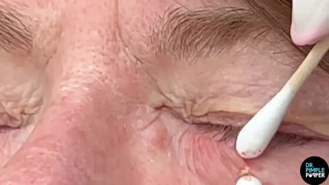 Blackhead Eye Squeeze