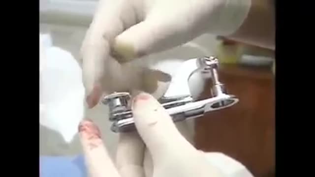 Gomco Clamp Technique