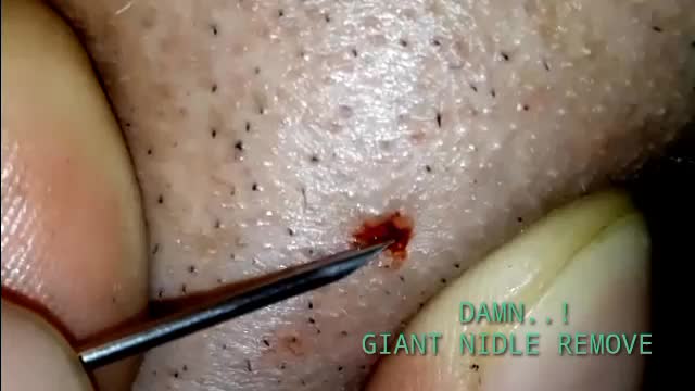 Damn..!!! Its Giant Nedlle Remove