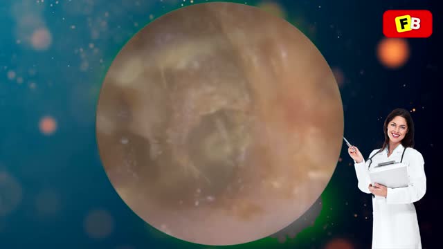 Ear Wax Removal PART 22