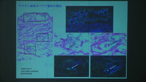 令和4年11月25日「新型コロナワクチン接種と死亡事例の因果関係を考える」勉強会