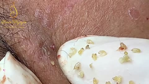 How to squeeze blackhead