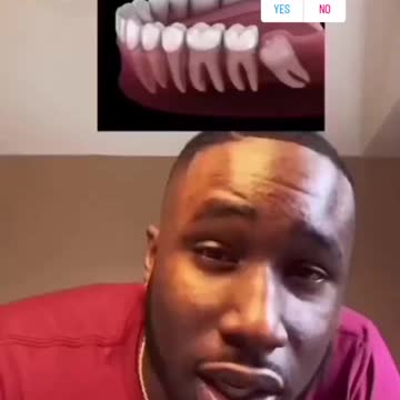 95% of wisdom teeth removals are unnecessary